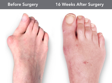 Lapiplasty R Lapiplasty - Foot and Ankle Centers of North Houston